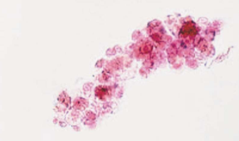 <ul><li><p>epithelial cells from renal tubules embedded in hyaline matrix</p></li></ul><p></p>
