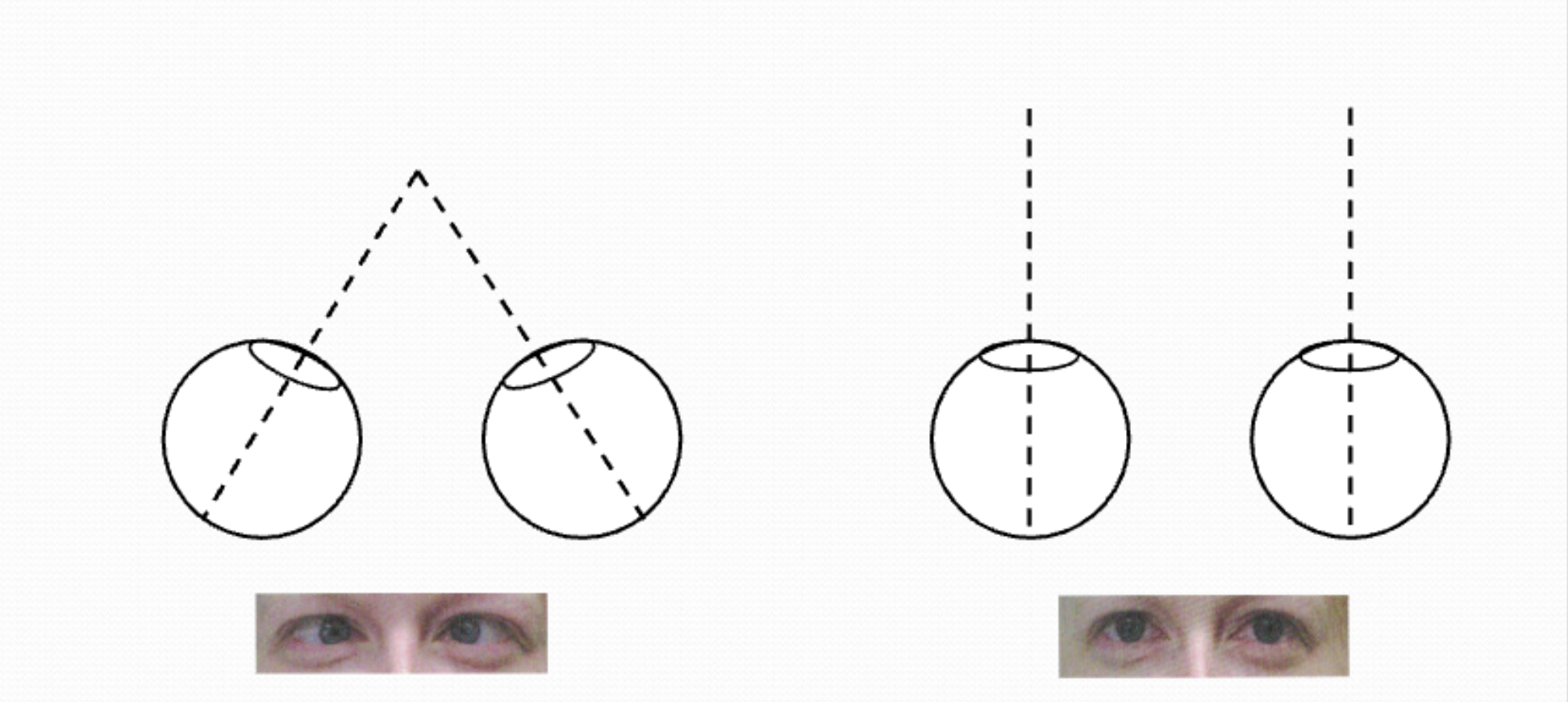 <p><span>the simultaneous, inward rotation of both eyes </span>towards<span> each other to focus on a single close object </span>.eyes converging, used to sense how far something is. </p>