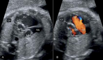 <ul><li><p><span style="color: red;">small LV</span></p></li><li><p>hypertrophied LV walls</p></li><li><p><span style="color: red;">mitral valve and AO are hypoplastic or atretic </span></p></li></ul><p></p>