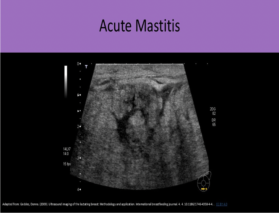 <p>C. decreased penetration due to tissue edema</p><p>Fluid in the breast tissues will cause an increase in the sound attenuation. This attenuation will reduce penetration and resolution.</p>