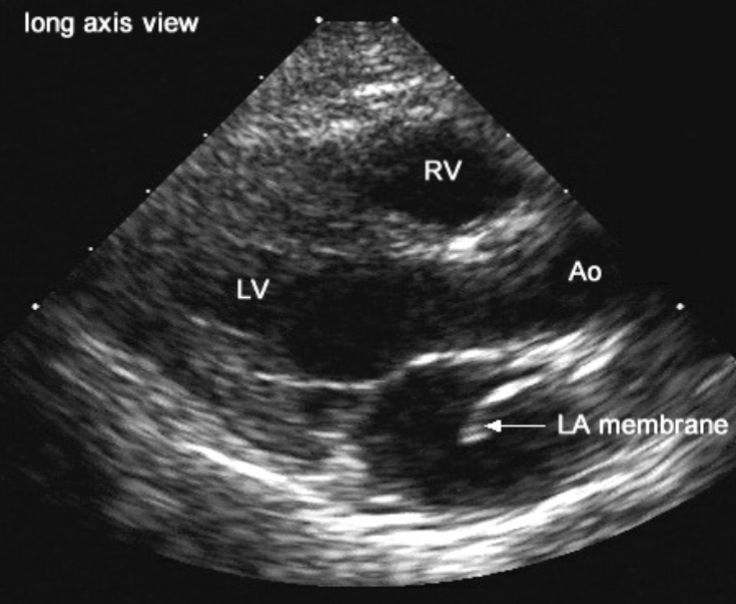 <ul><li><p>associated w/:</p><ul><li><p>ASD</p></li><li><p>PHTN</p></li></ul></li><li><p>complications:</p><ul><li><p>CHF</p><ul><li><p>d/t increased pressure in LA and PA w/ MS</p></li></ul></li></ul></li></ul><p></p>