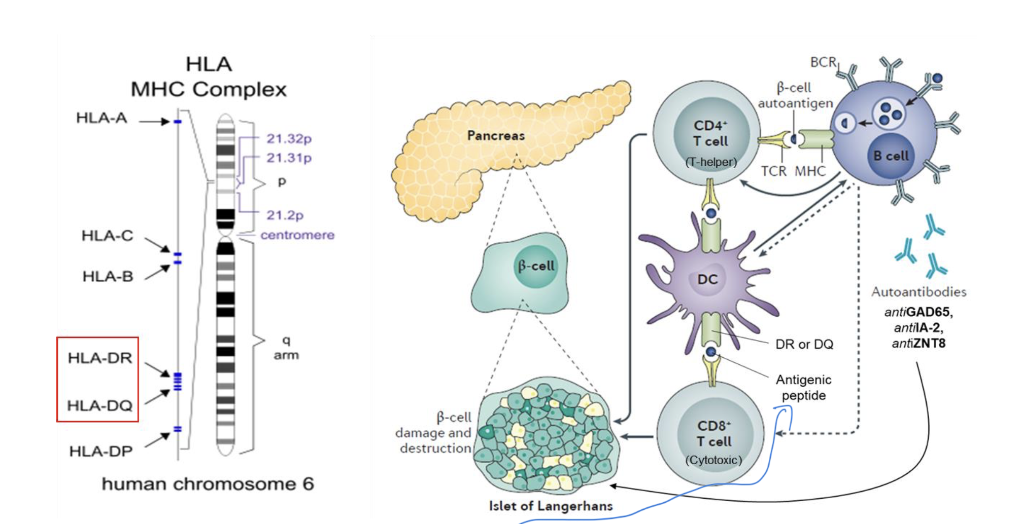 <ol><li><p>Dendritinė ląstelė pristato antigeną T helperiam. (antigeną pateikia HLA MHC kompleksas)</p></li><li><p>T helperiai aktyvuoja B limfocitus, gaminami antikūnai</p></li><li><p>T ląstelių puolimas sukelia insulitą</p></li></ol><p></p>