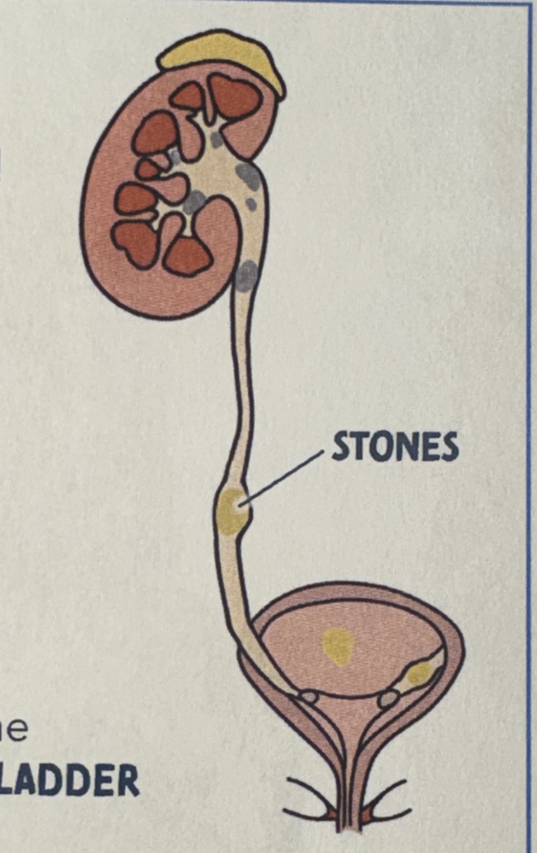 <p>Renal Colic</p>