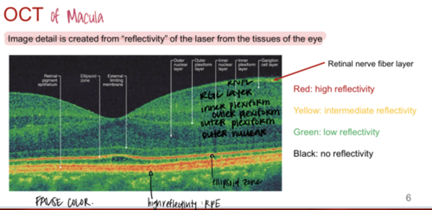 <p>What does YELLOW color mean in an OCT of the macula?</p>