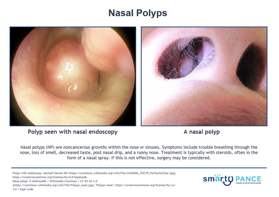 <p>Teardrop-shaped growths that form int he nose or sinuses, which is part of Samter’s triad with asthma and aspirin sensitivity </p><p>-Presentation: growths in the nose + chronic congestion + decreased sense of smell</p><p>-Dx: clinical</p><p>-Tx: topical nasal corticosteroid is initial treatment of choice, oral steroids can help reduce the size, surgery if polyps are large </p>