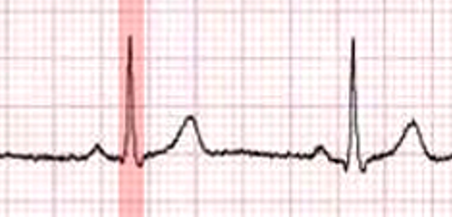<p>Name the highlighted deflection on EKG? </p>