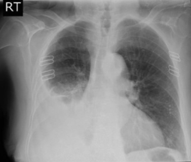 <p>is the attached image an example of effusion or infiltrate?</p>
