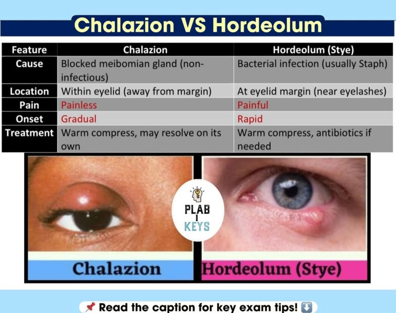 <p><u>hordeolum</u></p><ul><li><p>active lesion</p></li><li><p>new</p></li><li><p>painful</p></li><li><p>lower eyelid</p></li><li><p>“stye”</p></li></ul><p>TX: warm compress<br>PO abx</p><p><u>chalazoin</u></p><ul><li><p>inactive lesion</p></li><li><p>long standing</p></li><li><p>no pain</p></li><li><p>upper eyelid</p></li></ul><p>TX: warm compress<br>intense pulsed light therapy (IPL)<br>surgical excision</p>
