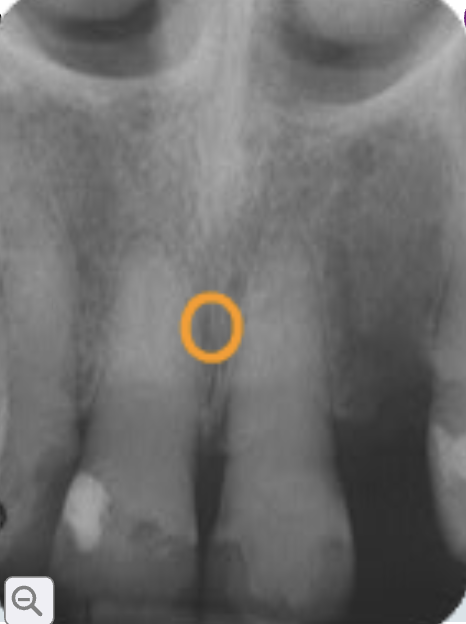 <p>incisive foramen</p>