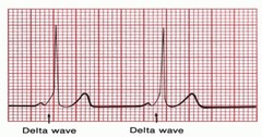 <p>an electrocardiography (ECG) finding that indicates ventricular preexcitation due to antegrade conduction over an accessory pathway, reentry of circuit.</p>