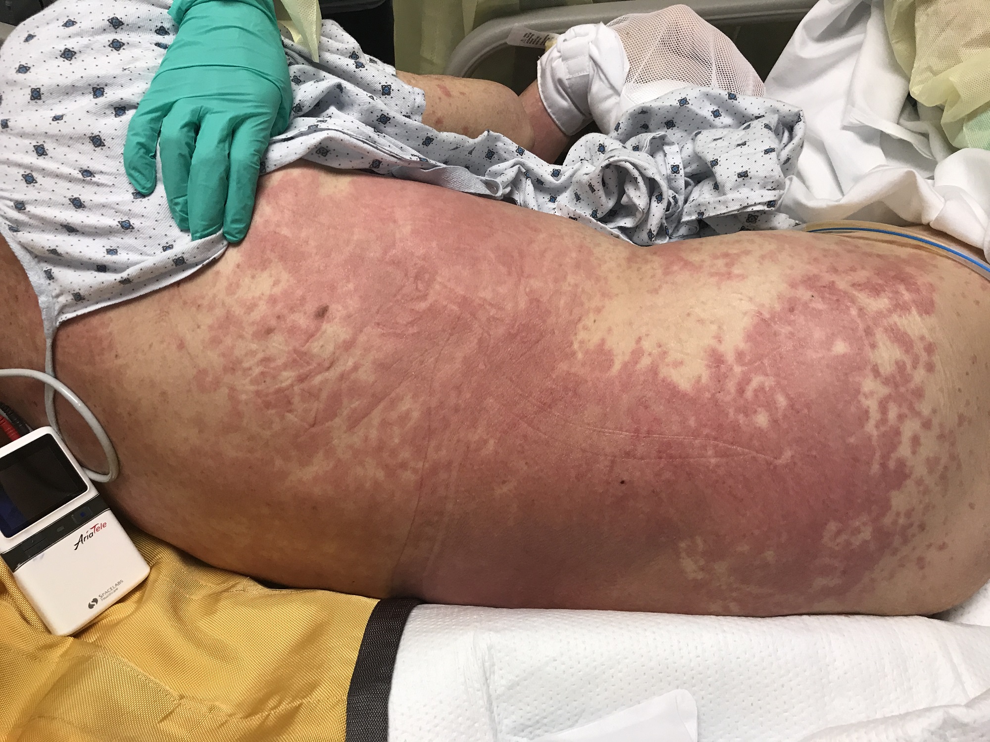 <p>Erythematous (air-ih-thee-ma-tus)</p>