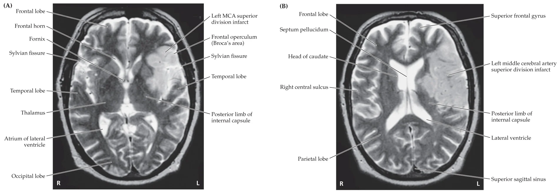 <p>left MCA superior division</p>
