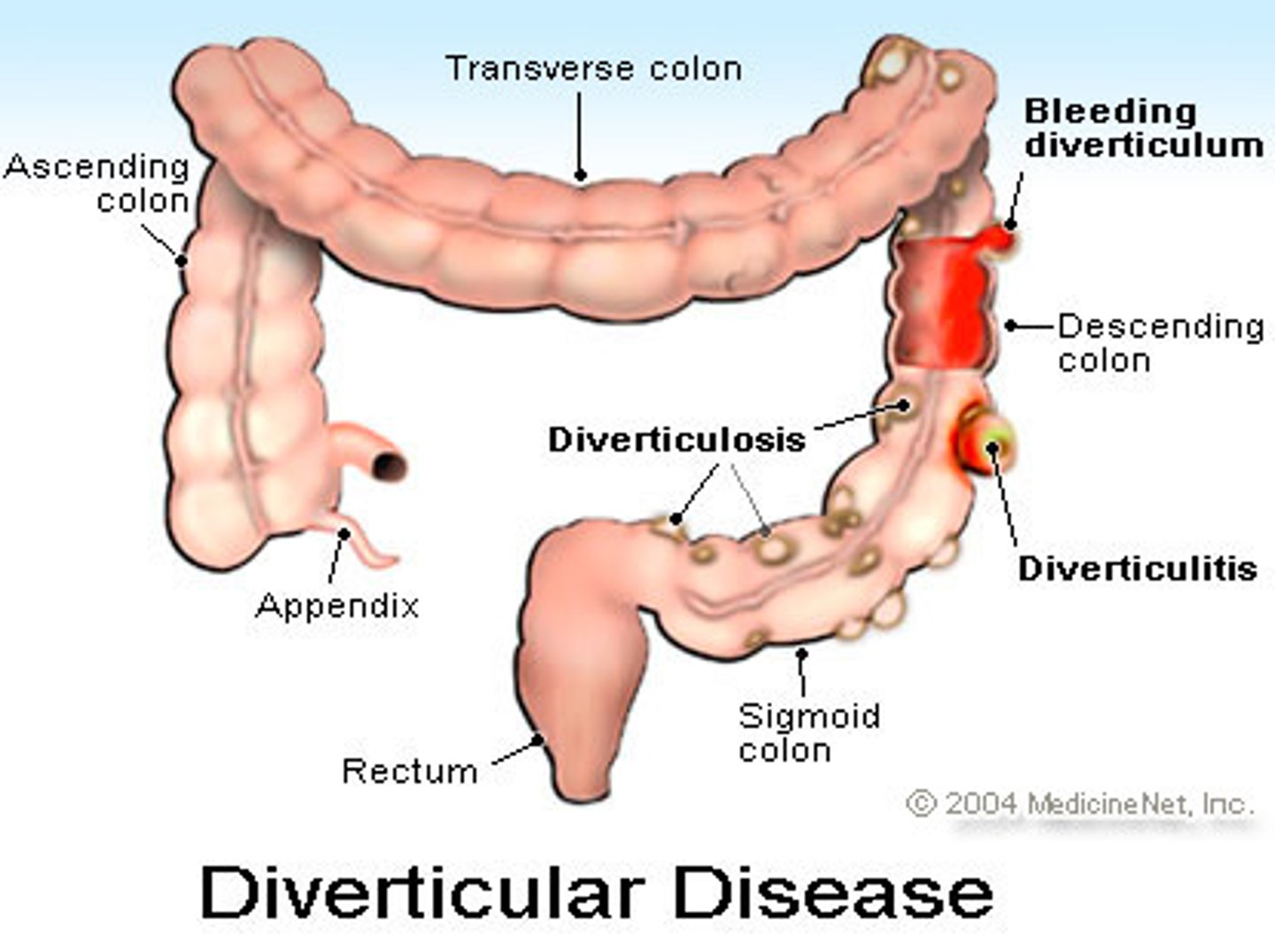 <p>diverticulosis</p>