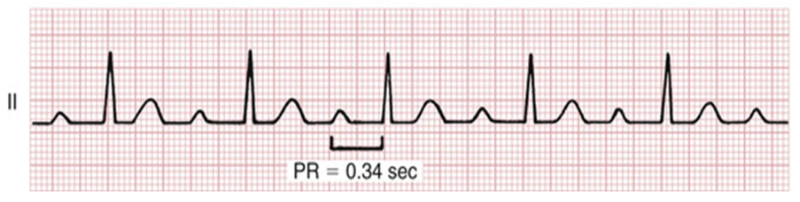 <p>how’d you know this was first degree HB</p>