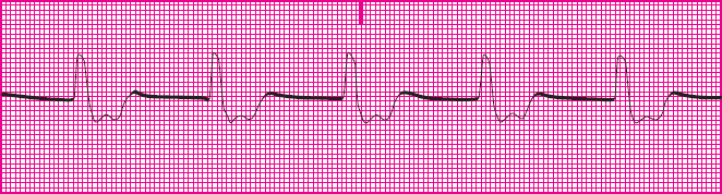 <p>Which rhythm is this?</p>