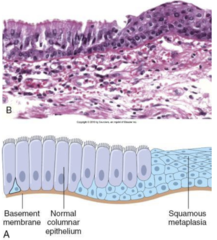 <p>premalignant condition where a cell type is replaced with a different cell type</p><p>Ex/barrett's metaplasia of the esophagus</p>