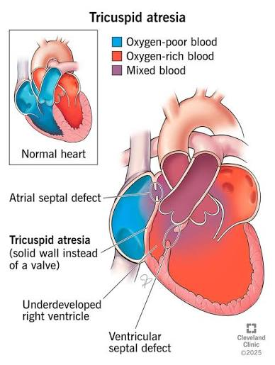 <p>Tricuspid Atresia</p>