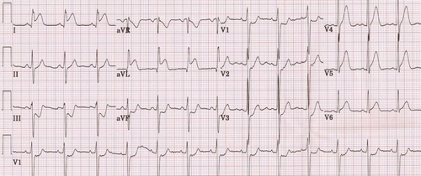 <p>howd yk this was Inferior Wall Myocardial Injury</p>