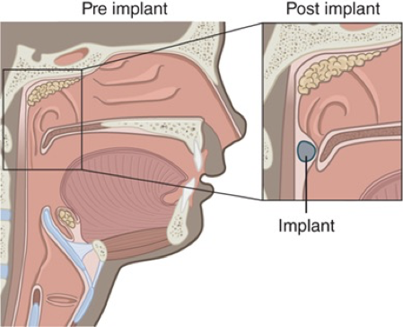 <p>What VPI surgery is this?</p>