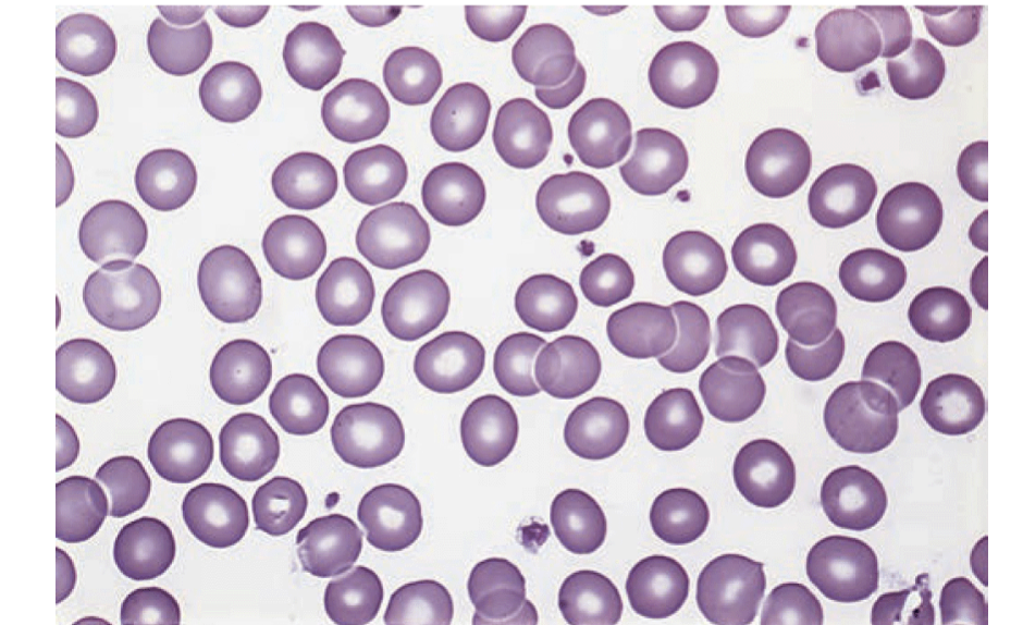 <p>What results indicate <strong>Sickle Cell Trait (HbAS)?</strong></p>