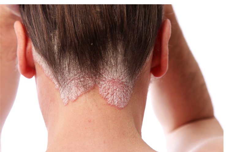 <ul><li><p>Psoriasis is a common chronic skin disorder most commonly characterized by <span style="color: yellow;"><strong>well-demarcated erythematous plaques with silver scale (“Plaque Psoriasis”)</strong></span> although other presentations can occur.</p></li></ul><p></p><ul><li><p>The immune system attacks healthy epidermal cells. </p></li></ul><ul><li><p>This misdirected attack leads to an overproduction of epidermal skin cells, causing them to build up on the skin’s surface and form the characteristic plaques and scales associated with psoriasis</p></li></ul><p></p>