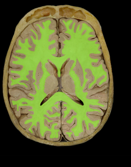 <p>White Matter</p>