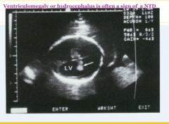 <p>Dilation of the cerebral ventricles without enlargement of the cranium. Occurs because of obstruction of outflow of CSF from the ventricles. Often sporadic and benign. Non-specific, but can indicate Dandy-Walker malformation, possible aneuploidy, variable future cognitive deficits</p>