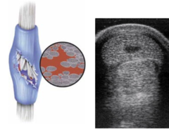 <p>Where do tendon injuries commonly occur? Why?</p>