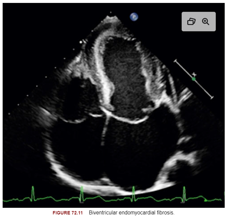 <ul><li><p>RCM</p></li><li><p>dense scarring of the mural endocardium</p></li><li><p>fibrosis predominated at the apieces and moved up toward the inflow tract</p></li></ul><p></p>