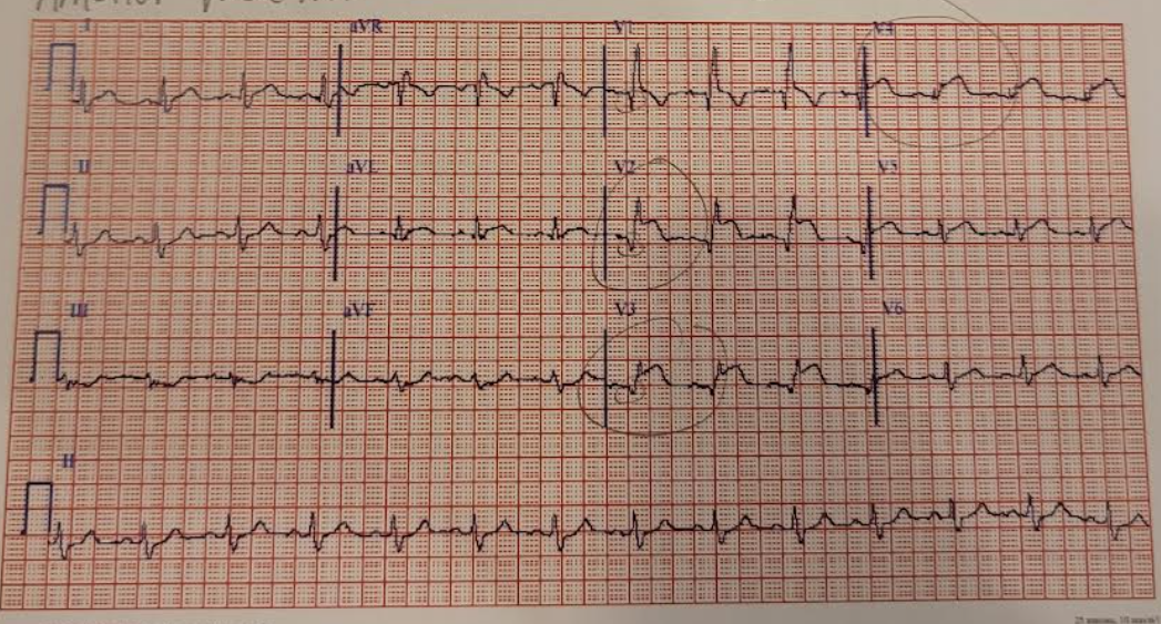 <p>why is this an ant wall AMI w injury</p>