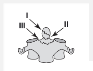 <p>What is a type I dens fracture?</p>