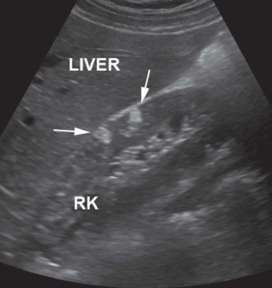<p>angiomyolipoma</p>