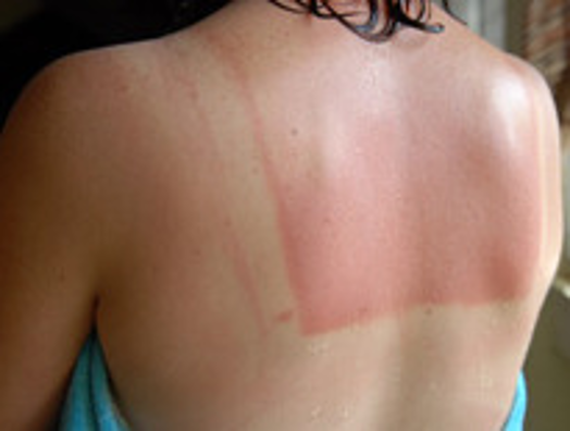 <p>epidermis only</p>