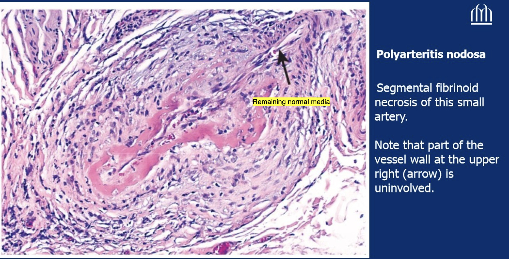 <p>Lumen is totally obliterated, neutrophils + chronic inflammatory cells are infiltrating the lumen; certain segments are necrotized but there is also remaining normal component.</p>