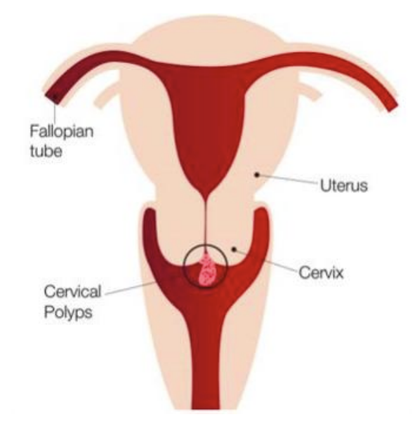 <p>Another example of squamous metaplasia can occur when an endocervical polyp (a polyp of endocervical tissue) projects down into the ectocervix and lies across the transformation zone.</p><p></p><p>As the polyp is now sitting in the ectocervix, its epithelium may respond to this change in environment by undergoing squamous metaplasia, changing from the single-layered, columnar glandular epithelium of the endocervix, into the squamous epithelium of the ectocervix. This metaplasia abundantly found on surface rather than within the glands.</p><p></p><p>NOTE: polyp will not have a transformation zone or SCJ as it is not anatomically derived from the area of the cervix where they are found. Instead, it will simply have some foci of squamous metaplasia, changing the polyp's native glandular epithelium to squamous epithelium.</p>