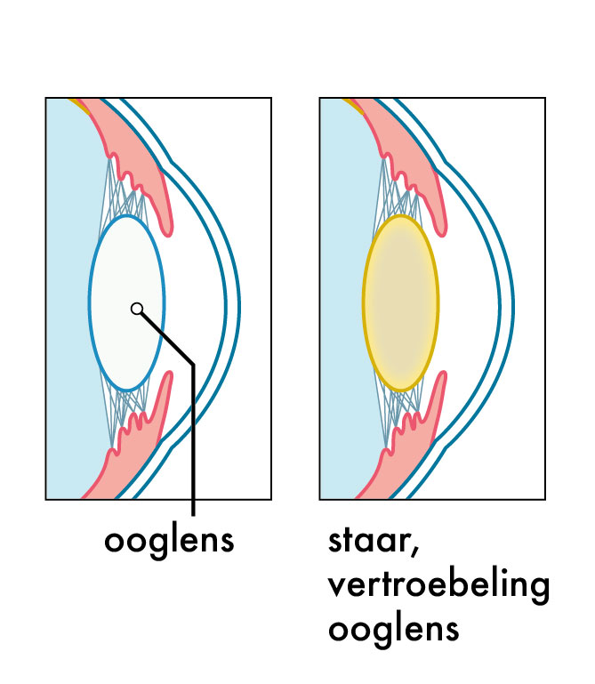 <p>ontstaat door de afzetting van troebele lensvezels in de lens van het oog.</p><ul><li><p><strong>Symptomen:</strong> De belangrijkste klachten zijn een wazig zicht en lichthinder.</p></li><li><p><strong>Risicofactoren:</strong> Naast een hogere leeftijd zijn blootstelling aan zonlicht en diabetes mellitus belangrijke risicofactoren.</p></li></ul><p></p><p></p>
