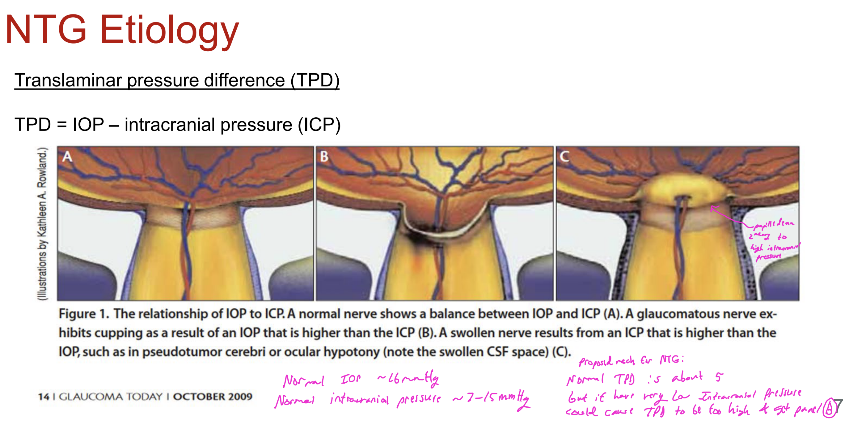 <p>A swollen nerve results from what?</p>