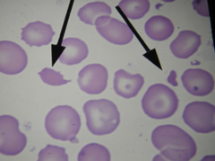<p>RBCs split by fibrin strands. Microangeopathic hemolytic anemias (DIC, TP, HUS), prosthetic heart valves</p>