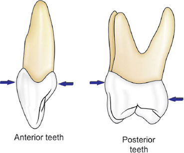 <p>½ mm or less, ¾ mm (facial surface of 2nd premolar), 1mm (facial surface of 1st molar and 2nd molar)</p>