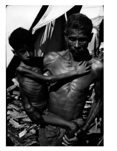 <p>Low protein and calorie malnutrition</p><p>Body switches to starvation mode</p><p>Use energy reserves </p>