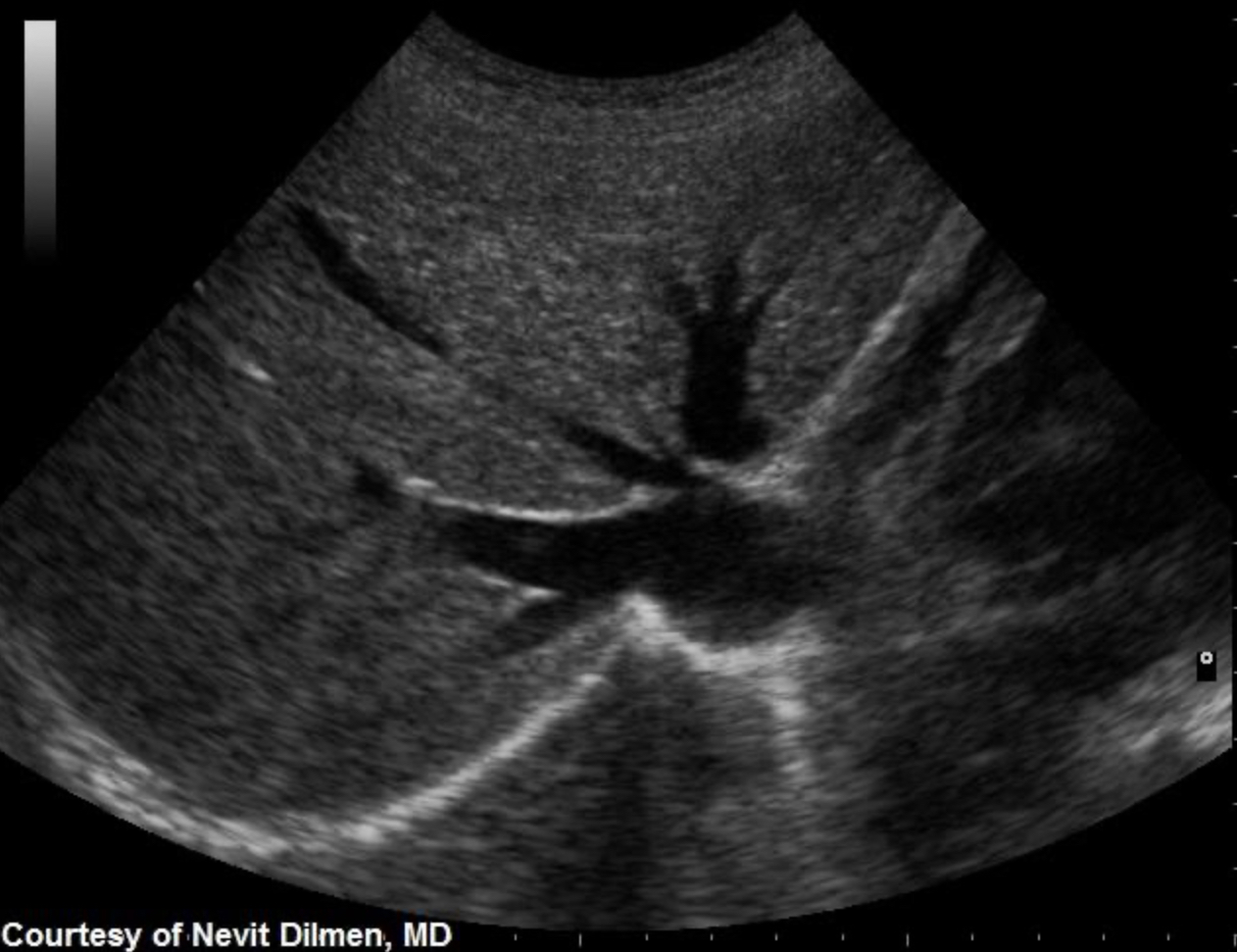 <p>Use your mouse to place your cursor over the left medial superior segment of the liver and click to mark the structure</p>