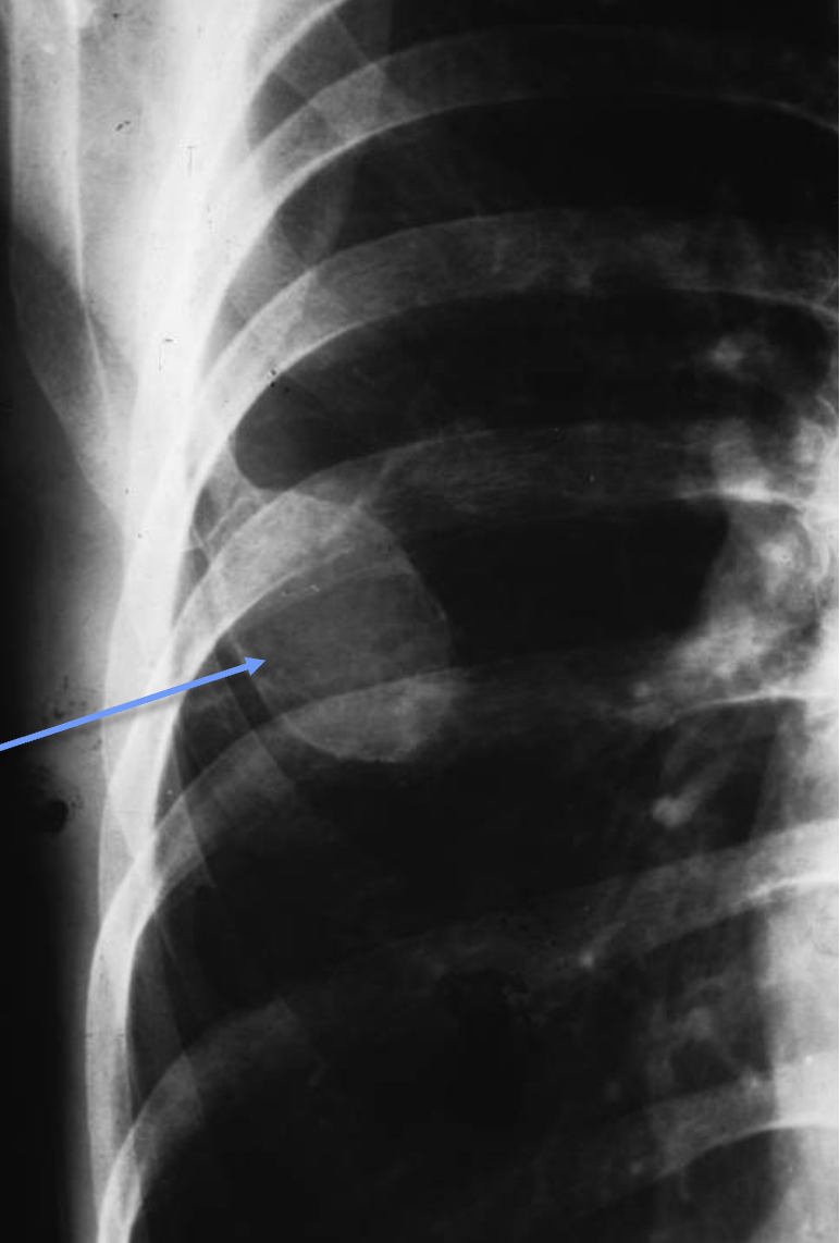 <p>What tumour like disorder is this, what can you see?</p>