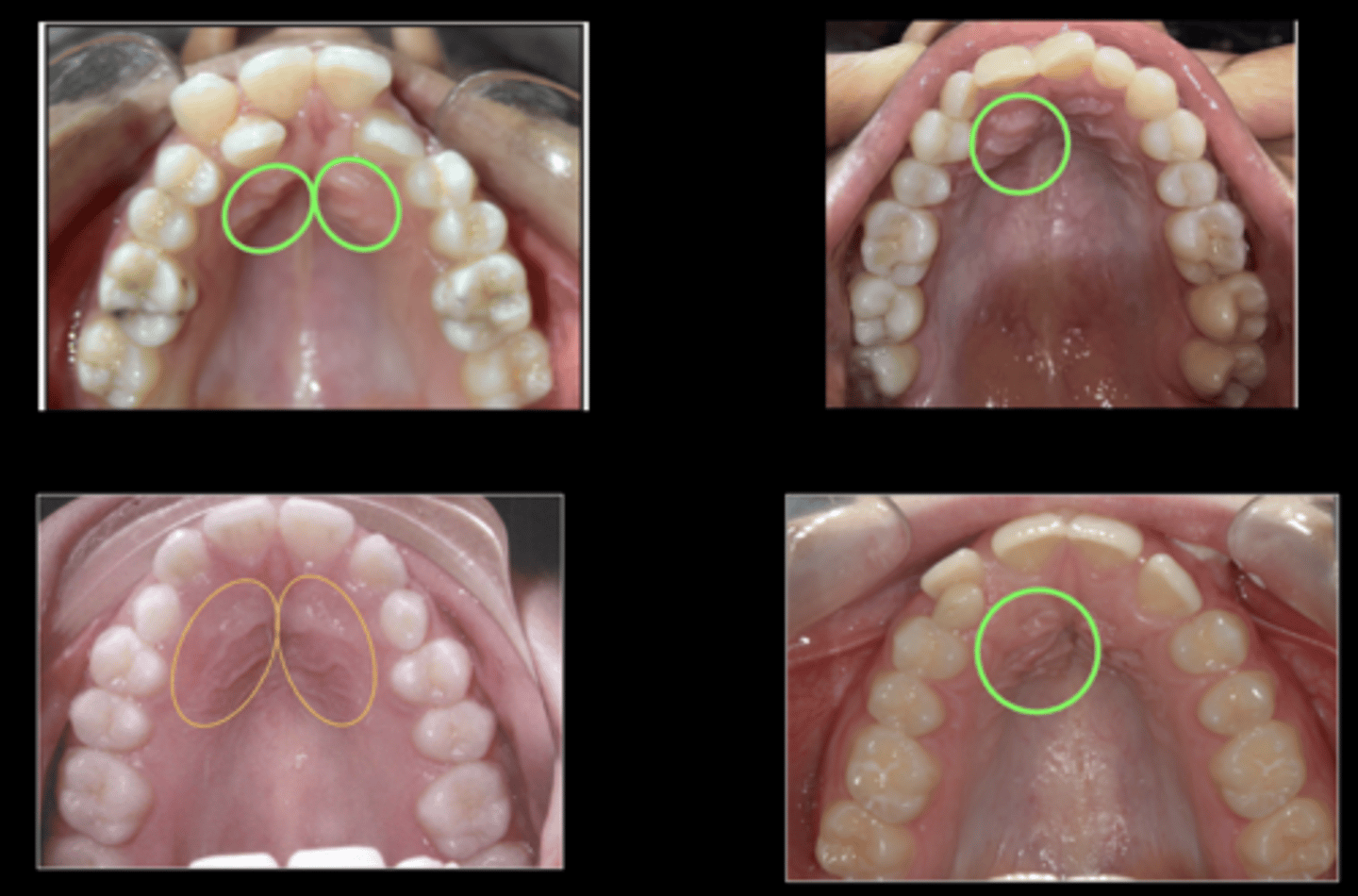 <ol><li><p><u>Lack of a distinctive cuspid bulge</u> on the <strong>labial</strong></p></li><li><p>Evidence of a <strong>palatal bulge</strong></p></li></ol><p></p>