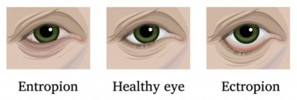 <p>PP: eyelid turns outward→eyelid+eye exposed</p><p>E: m/c→involutional (skin shrinking with age)<br>tumors<br>trauma<br>7th nerve paralysis<br>congenital<br>-lower eyelid (m/c)</p><p>CM: red portion of lower eye</p>