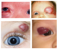 <p>What is the most likely diagnosis ?</p>