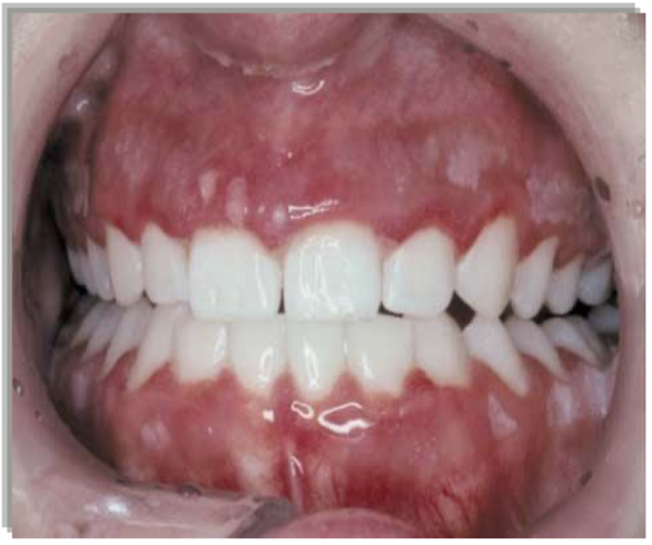 <p>what is this lesion and what is it associated with</p>