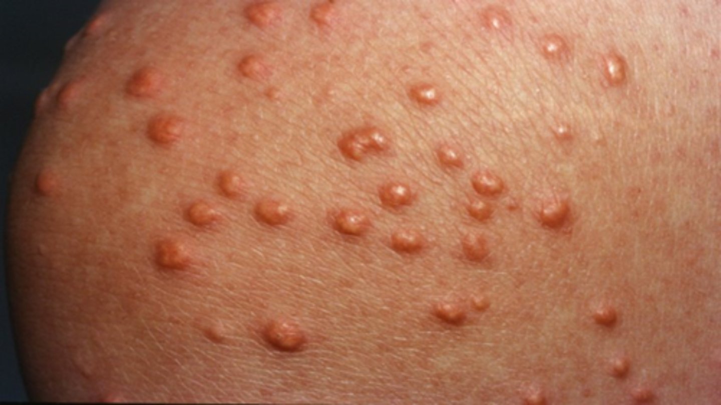 <p>red-yellow papules</p>