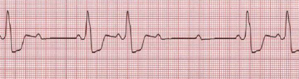 <p>Mr. Roque after his interview experienced chest heaviness, retrosternal 10/10 radiating to the left shoulder. He was brought to the ER by his bodyguard. ECG shows</p><p>A. LVH by voltage</p><p>B. Complete AV block</p><p>C. NSTEMI</p><p>D. STEMI</p><p></p><p>What is the most likely ECG diagnosis in this patient?</p><p>A. Complete heart block</p><p>B. Mobitz type I</p><p>C. Mobitz type II</p><p>D. ST elevation</p>