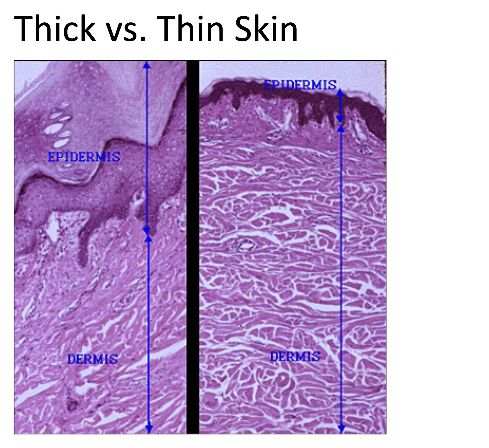 <ul><li><p>areas where friction commonly develops </p></li><li><p>palms, feet, fingertips </p></li><li><p>FIVE epidermal layers </p></li><li><p>thick/larger epidermis (keratinized layer) </p></li></ul><p></p>