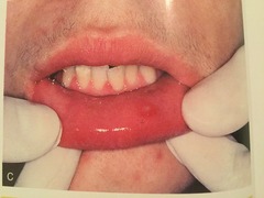 <p>-cold sores in the mouth, usually in children (HSV-1)</p><p>-represents initial infection that recurs as fever blisters</p>